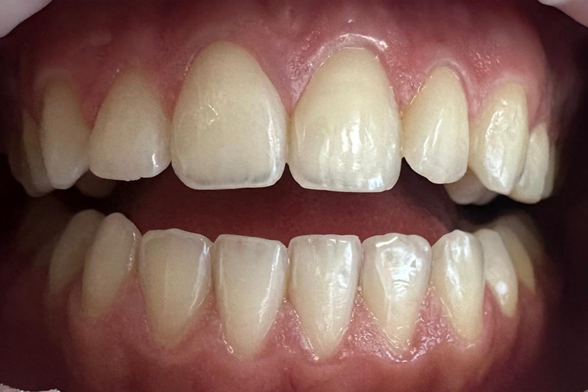 Smile study — Before