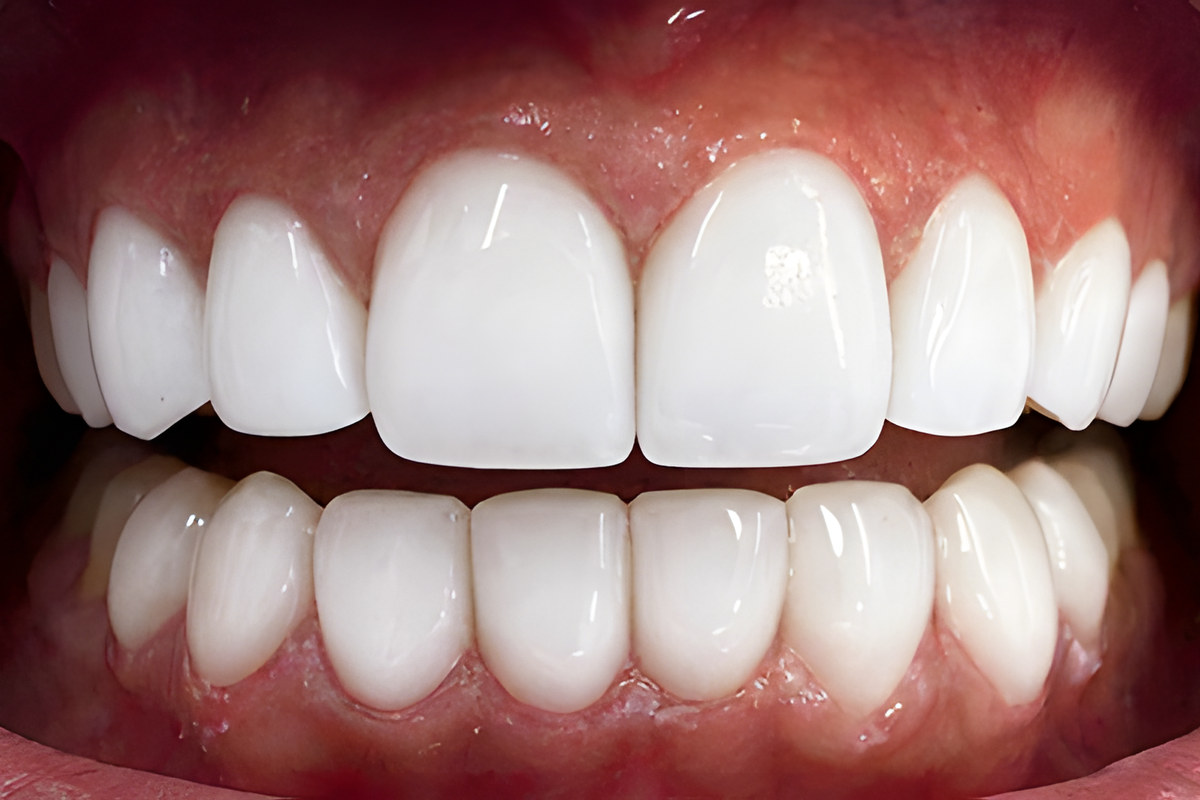Smile study — After