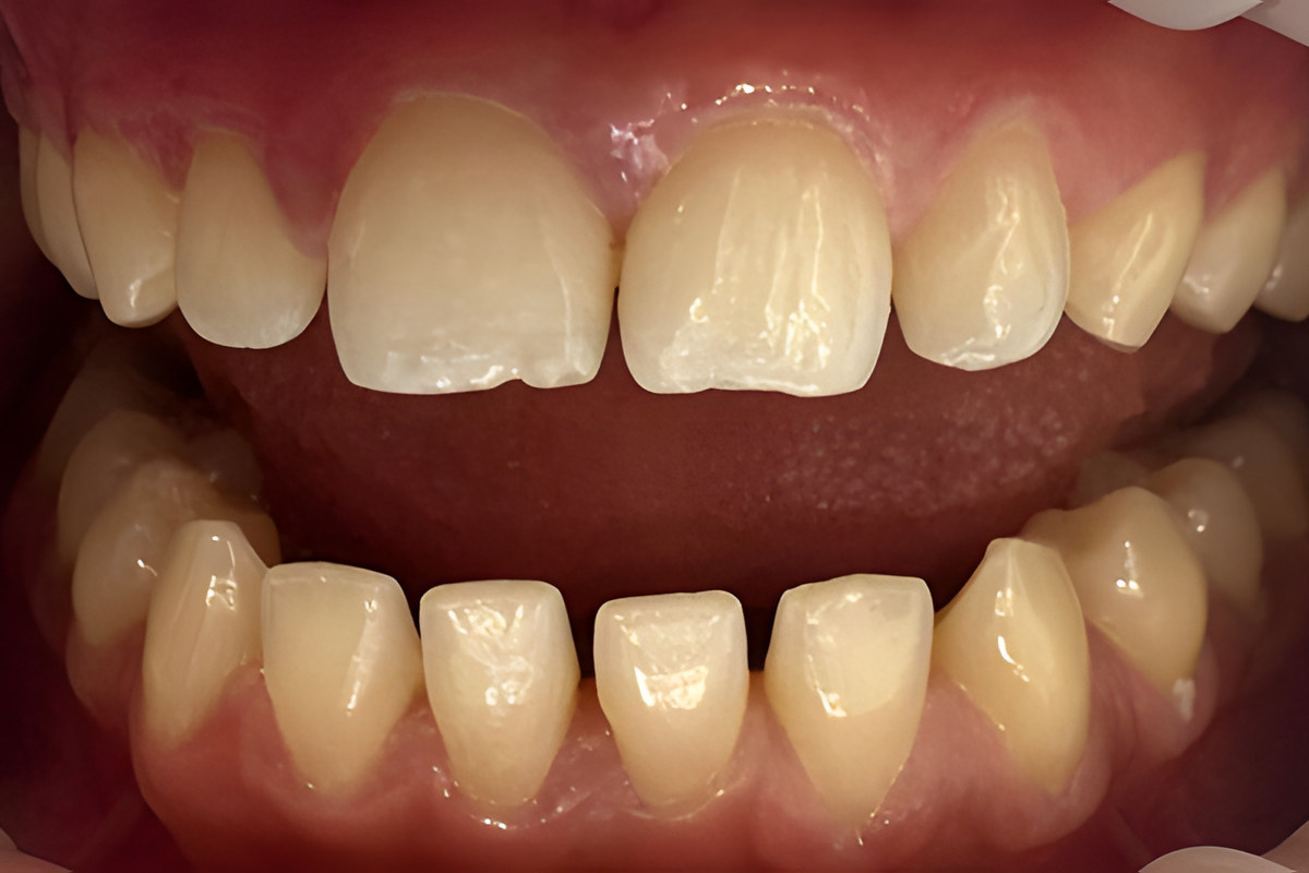 Smile study — Before