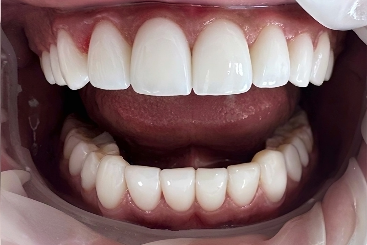 Smile study — After