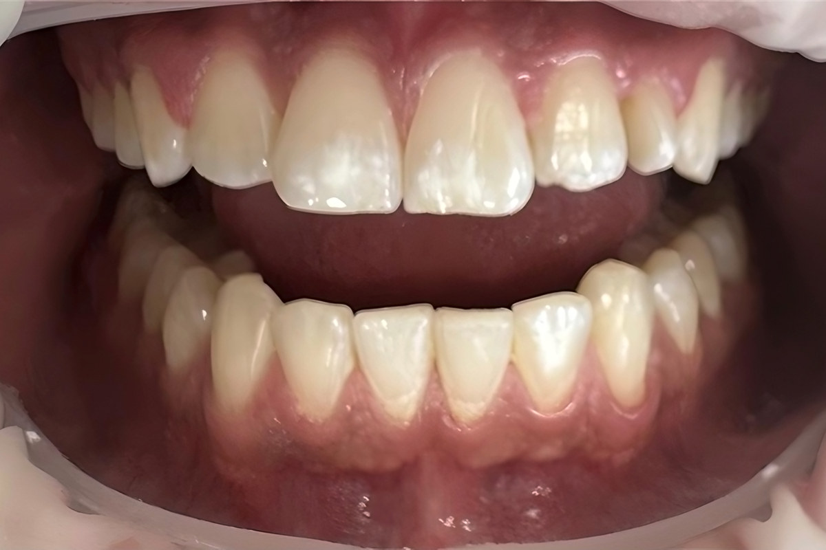 Smile study — Before
