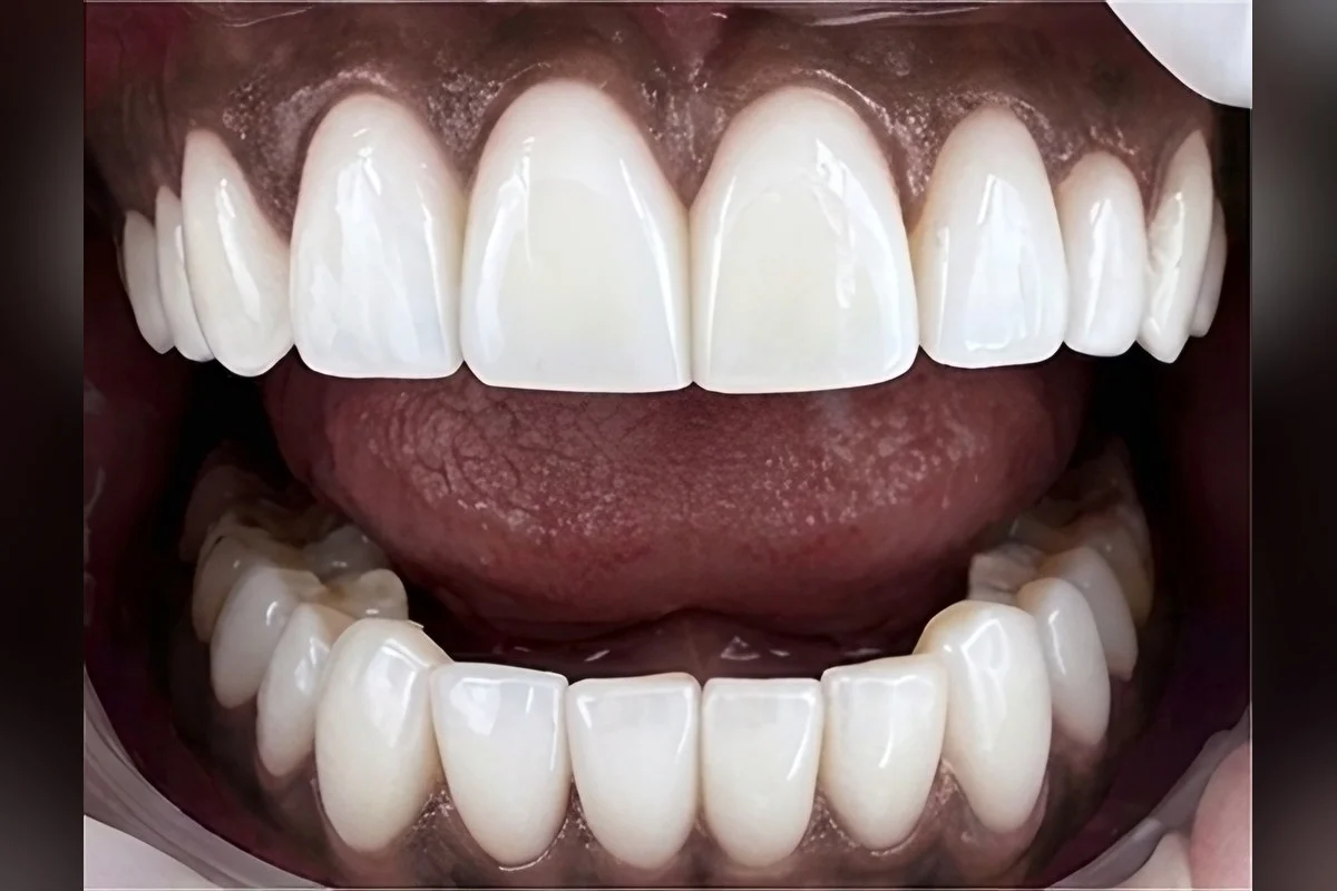 Smile study — After
