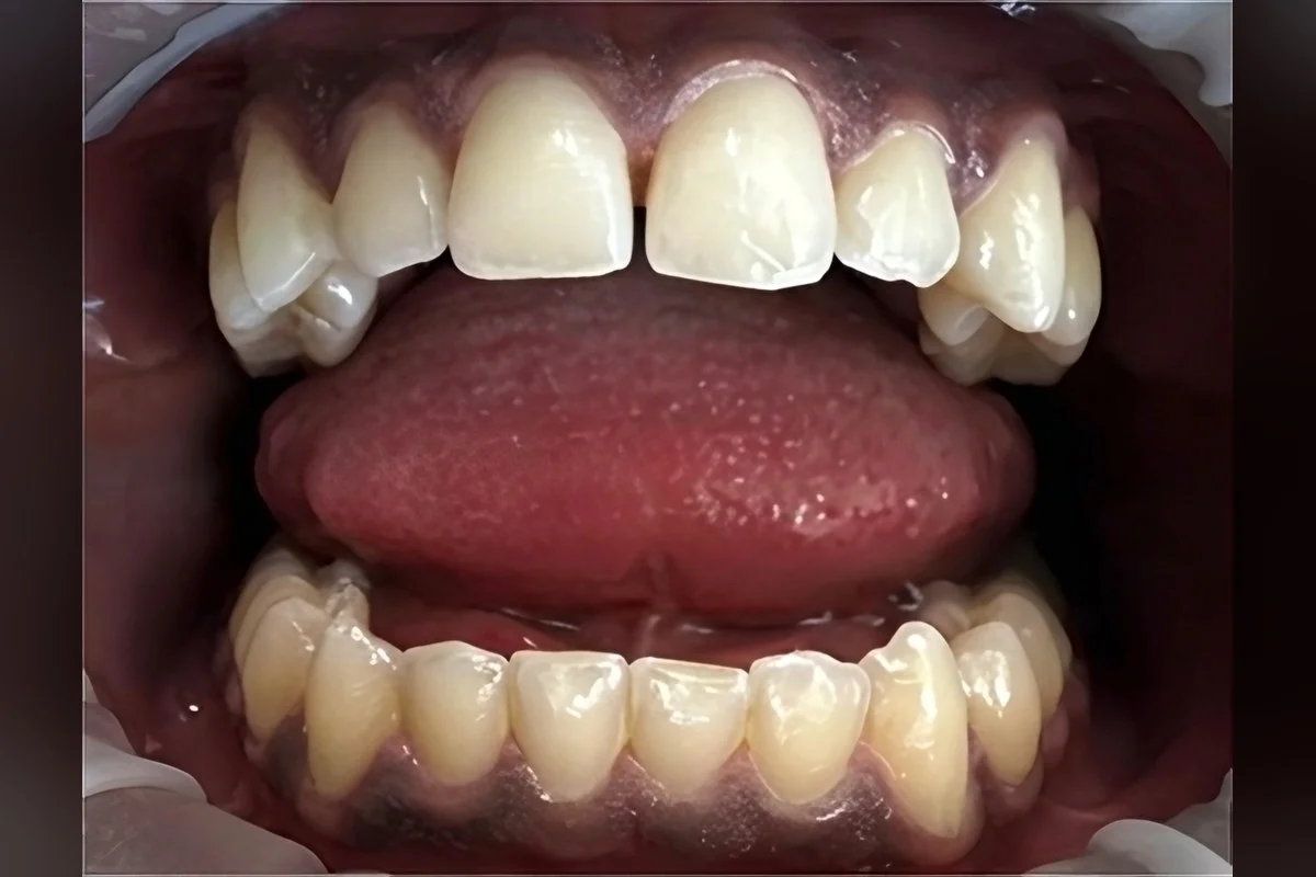 Smile study — Before