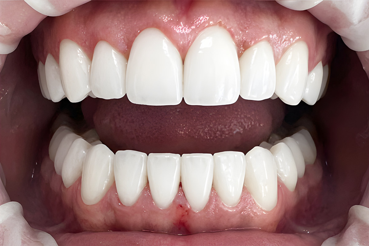 Smile study — After