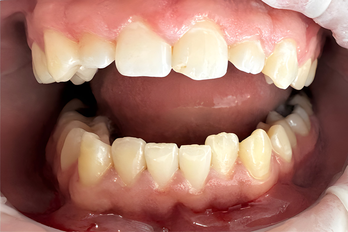 Smile study — Before